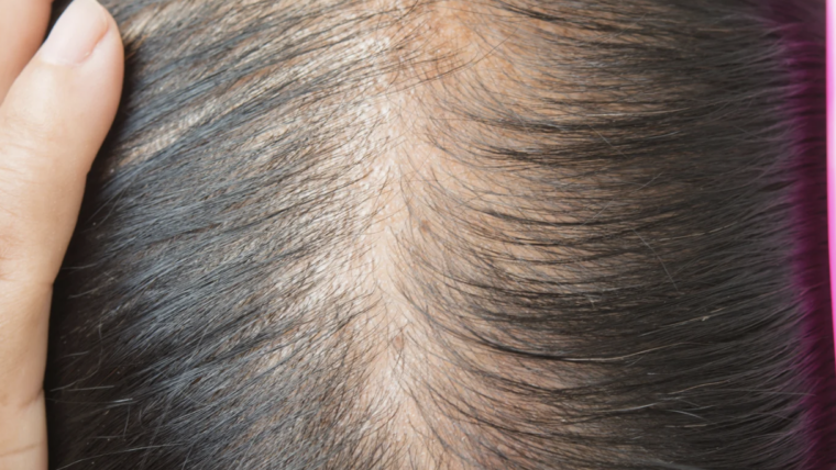 How to Choose the Right Hair Loss Specialist in Maryland